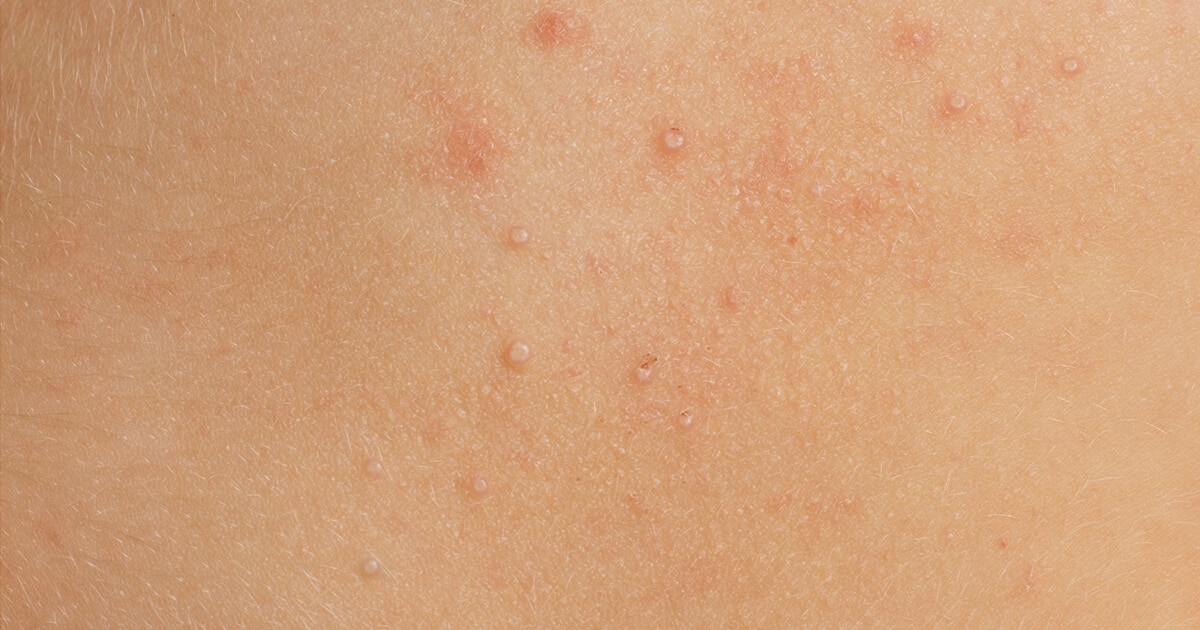 Molluscum Contagiosum: Symptoms, Causes, Treatment, and Effective Prevention